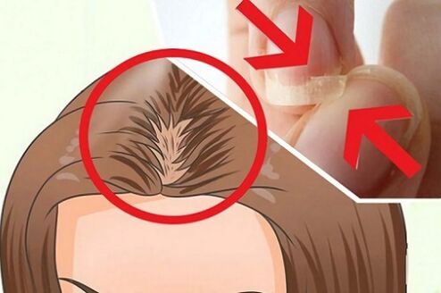 hair and nail problems with parasites