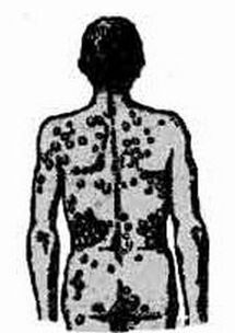 scheme of possible infection